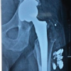 Delayed Presentation of Ceramic Liner Fracture Following Ceramic-on-Ceramic Total Hip Arthroplasty: A Case Report