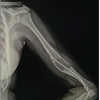 Revision Reconstruction of a Humeral Simple Bone Cyst Using Fibular Strut Graft, Iliac Crest Bone Graft, and Posterior Plating in a Young Adult: A Case Report