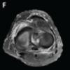All-inside Circumferential Fiber Augmentation of Medial Meniscus Combined with Medial Open-wedge High Tibial Osteotomy