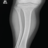 Plastic Bowing of the Pediatric Tibia is Extraordinarily Rare and Not Represented in the Literature, the Unicorn of Pediatric Fractures: A Case Report