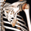 Modified Posterior Approach for Scapular Body Non-union: A Case Report