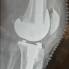 One-Stage Revision for Low-Grade Periprosthetic Infection with Staphylococcus hominis Following Cruciate-Retaining Total Knee Arthroplasty: Case Report and Literature Review