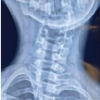 Chronic Irreducible C1–C2 Rotatory Subluxation Presenting as Painful Torticollis in a Child Managed with Posterior Lateral Mass Fixation: A Case Report