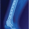 Outcomes of Open Reduction and Internal Fixation in Intra-articular Distal Femur Fractures with Incarcerated Patella: A Case Series of a Rare Injury Pattern