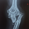Clinical-Radiological Dissociation after Failed Monteggia Fixation: Preserved Function at 2 Years Despite Proximal Ulnar Fibrous Non-union and Chronic Lateral Radial Head Dislocation