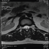 Use of Lumbosacral Myofascial Release and Therapeutic Exercises for a Patient with Bertolotti’s Syndrome: A Case Report