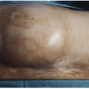 Undifferentiated Pleomorphic Sarcoma with Dual Smooth-Muscle and Osteogenic Differentiation Mimicking Plasma Cell Dyscrasia: A Rare Diagnostic Pitfall