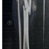 Gold or Dust: A Prospective Study of Tibial Shaft Fractures Treated with Interlock Nail and Percutaneous Injection of Reamed Autologous Cells
