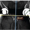 Intraoperative Assessment of Combined Anteversion Using the Ranawat Technique with a Smartphone Application: A Prospective Computed Tomography-based Agreement Study in Uncemented Total Hip Arthroplasty