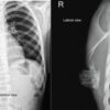 Paediatric Pedunculated Dorsal Osteochondroma of the Scapula: A Medical Oddity with Review of Literature
