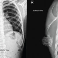 Figure 1: Roentgenogram anteroposterior and lateral views depicting bony outgrowth from the dorsomedial aspect of right scapula.