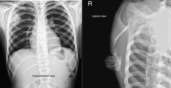 Figure 1: Roentgenogram anteroposterior and lateral views depicting bony outgrowth from the dorsomedial aspect of right scapula.