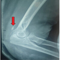 Figure 1: Lateral radiograph of the left elbow demonstrating the Fleck sign (red arrow), suggestive of distal triceps tendon avulsion.