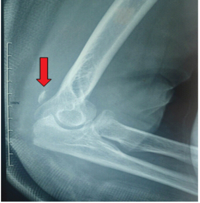 Figure 1: Lateral radiograph of the left elbow demonstrating the Fleck sign (red arrow), suggestive of distal triceps tendon avulsion.