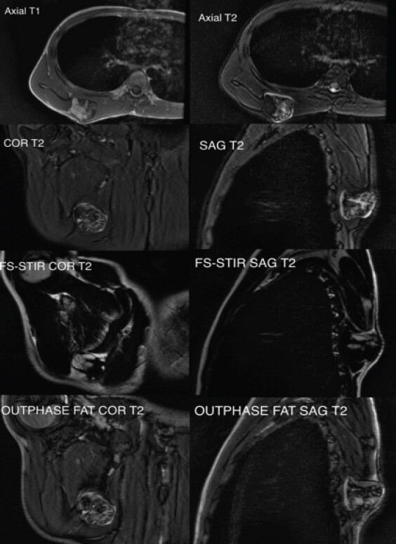 Figure 2: Magnetic resonance imaging sequences (sagittal, axial, and coronal) delineated a visible cartilaginous cap with surrounding fatty marrow and edema. Fat-suppressed short tau inversion recovery images (sagittal and coronal) obtained, which showed high signal intensity (cartilage) and the thickness of cartilaginous cap to be 14 mm. Out-of-phase (Opposed phase) fat-suppressed images showed hyper-intense signal depicting near total tumor replacement of the osseous lesion.