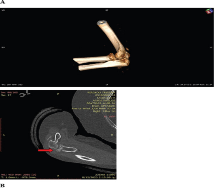 Figure 2: Computed tomography scan of the left elbow. (a) 3D view. (b) Comminuted intra-articular radial head fracture (red arrow), classified as Mason type III.