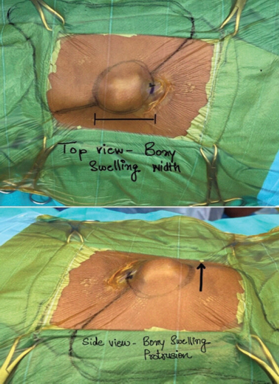 Figure 3: Intraoperative prone positioning with osseous mass centered, the draping depicting width and protruding height of the lesion.