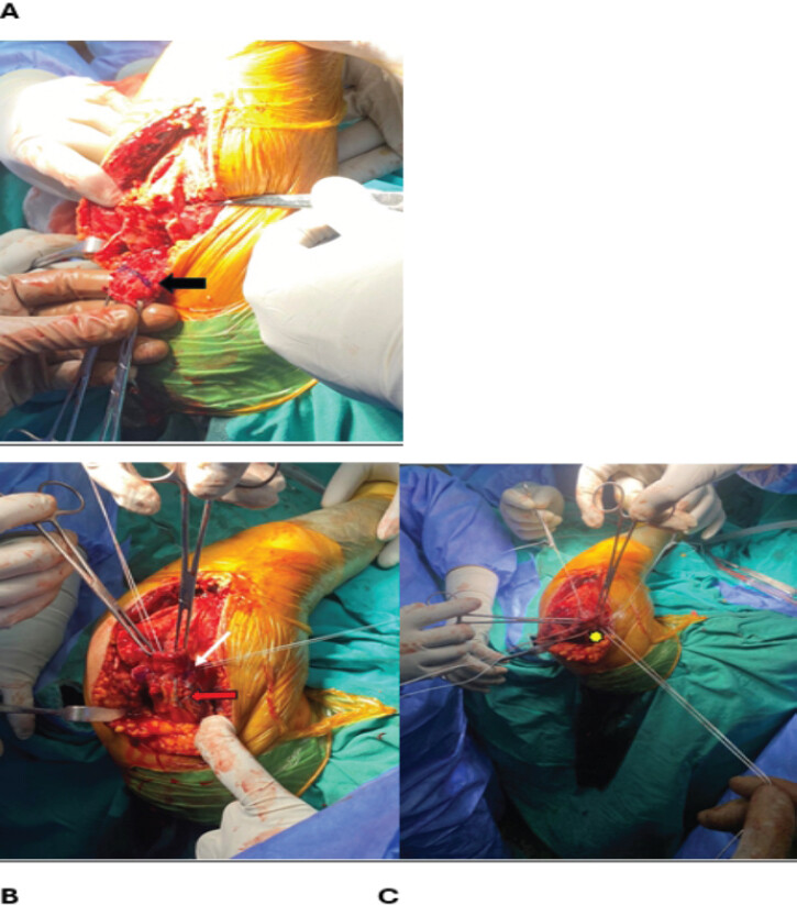 Figure 3: Triceps tendon preparation. (a) Identification and marking of the triceps footprint(black arrow). (B) Placement of medial and lateral Krackow sutures (red arrow) exiting anteriorly(white arrow). (c) Placement of FiberLoop sutures with posterior loop exit(star).