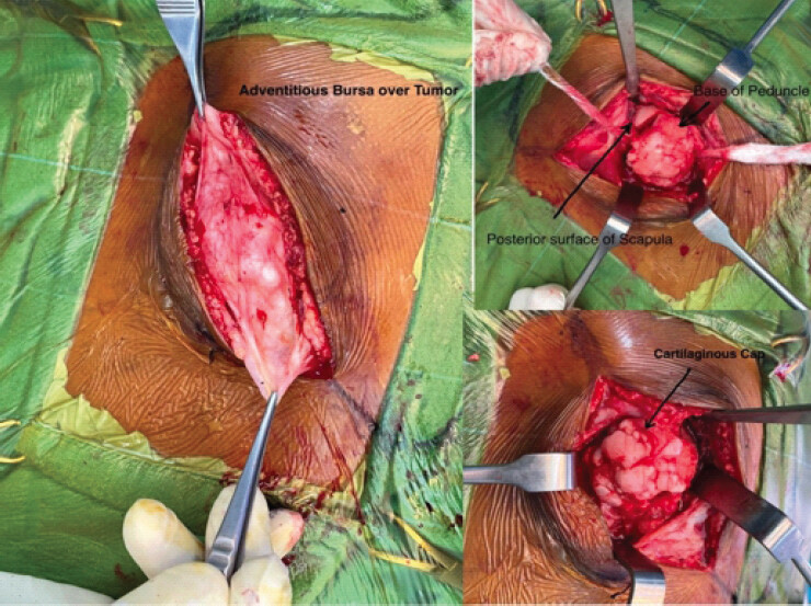 Figure 4: Removing adventitious bursa overlying the tumor and exposing the tumor circumferentially, osteotomize the base of the peduncle till the posterior cortex of scapula.