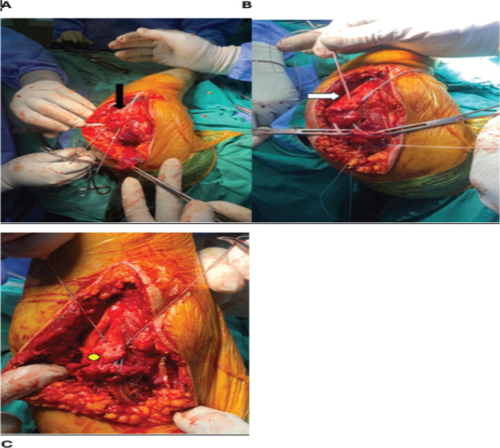 Figure 4: Olecranon preparation and suture passage. (a) Creation of two parallel bone tunnels(black arrow). (b) Passage of suture limbs through the tunnels (white arrow). (c) Creation of the “box-and-X” footprint configuration (yellow star).