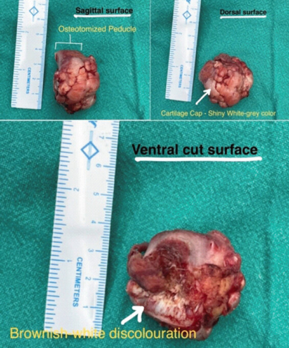 Figure 5: Gross section images of the tumor mass excised measuring 3.8 × 3.2 ×4 cm with ventral cut surface showed brownish-white color. Cartilaginous cap can be appreciated as shiny white-grey color over the dorsal surface. Tumor peduncle can be seen on the sagittal surface.