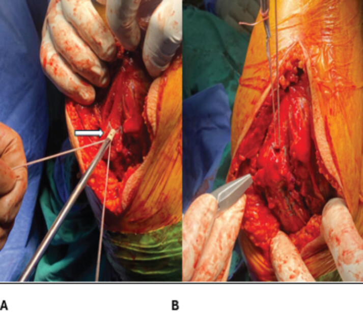Figure 5: Final triceps tendon repair. (a) Passage of the Krackow sutures through the anchor(white arrow) (b) Final tensioning and fixation of the repair.