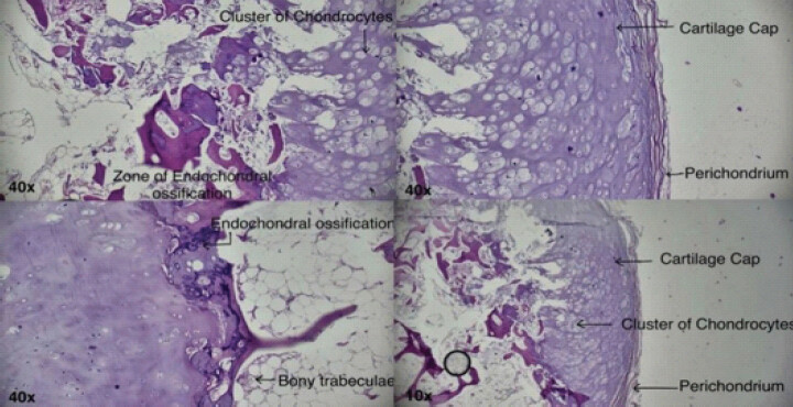 Figure 6: Histopathological examination delineated fibrous perichondrium, hyaline cartilage (×10), island of bony trabeculae and junctional endochondral ossification (×40).
