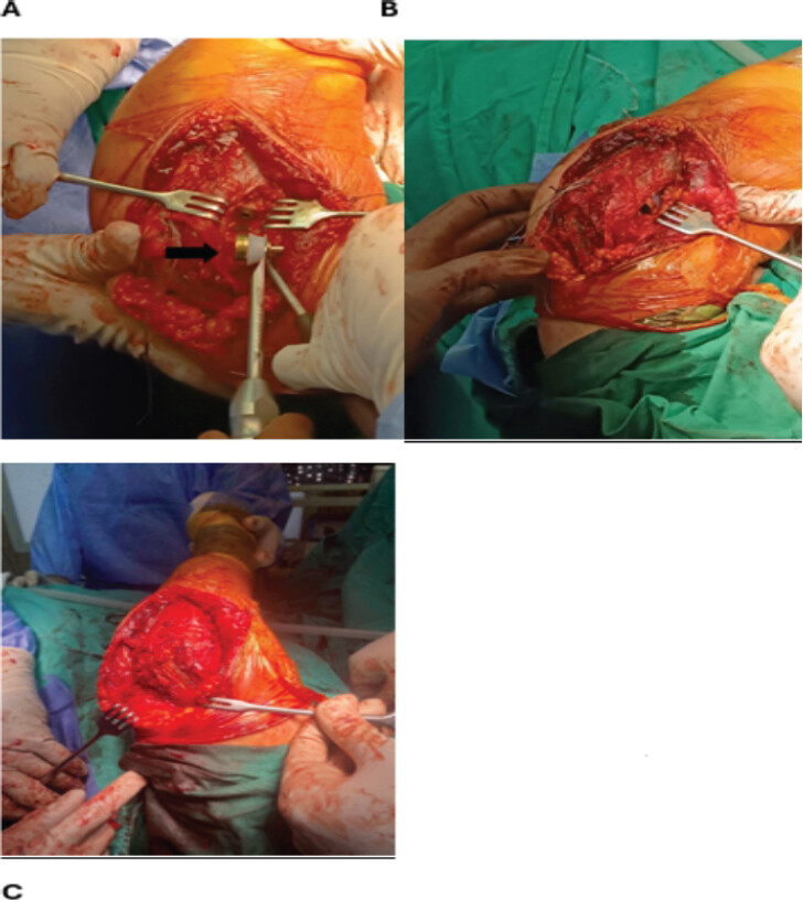 Figure 6: Radial head arthroplasty. (a and b) Exposure and preparation of the radial head-Press-fit radial head prosthesis implantation (black arrow). (c) Final intraoperative view.