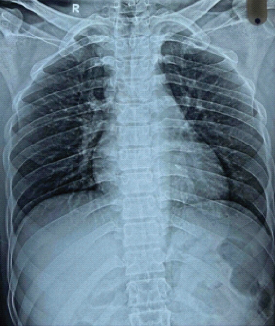 Figure 7: Post-operative roentgenogram anteroposterior view of right scapula depicting complete removal of the bony growth.