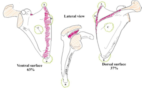 Figure 8: Image representing zones of scapular tumor by musculoskeletal tumor society (Pink: S1 zone, Orange: S2 zone) along with common mass location (A, B, C, D).
