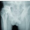 The Destructive Power of Circumstance on Concurrent Poliomyelitis and Osteomyelitis