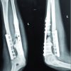 Modified Nicoll’s Graft for Treatment of Gap Non-union of Ulna: A Rare Case Report