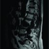 Parvimonas micra Spondylodiscitis: A Case Report and Systematic Review of the Literature