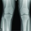 Acute traumatic proximal tibiofibular dislocation: Treatment of three cases