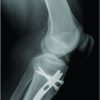 Heterotopic Ossification following Suprapatellar Intramedullary Nailing