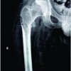 Fragility Fracture of Proximal Femur in a Paraplegic Patient during Passive Joint Movements