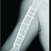 A Recurrent Stress Fracture of the Humerus following Fixation: The Effect of Implant Stress Shielding