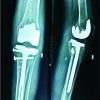 Complex Proximal Malunited Tibial Plateau FractureTreated Primarily by Total Knee Arthroplasty-A Case Report