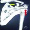 Triple Disruption of the Superior Shoulder Suspensory Complex – A Case Report