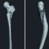 The Reversed Less Invasive Stabilisation System-Distal Femur Technique: Application in an Adult Patient with Osteogenesis Imperfecta Sustaining a Femoral Fracture