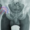 Computer-assisted Navigation in Hip Resurfacing Arthroplasty: A Case Study utilizing the ReCap Femoral Resurfacing System