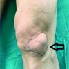 A Giant Ganglion Cyst Arising from Lateral Hoffa’s Fat Pad of the Knee