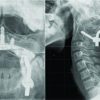 Rotatory Subluxation and Facet Deformity in the Atlanto-occipital Joint in Patients with Chronic Atlantoaxial Rotatory Fixation: Two Case Reports