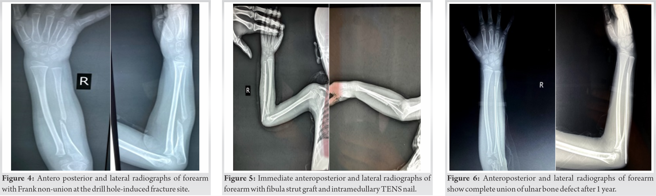 FIg 4 5 6 | Journal of Orthopaedic Case Reports