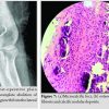 Calcific Tendonitis of the Elbow in an Adult – A Case Report and Review of the Literature