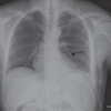 Pneumothorax After Shoulder Arthroscopy: A Rare but Life-threatening Complication