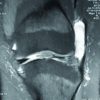 Intra-articular Fibroma of Tendon Sheath in Knee Joint Associated with Iliotibial Band Friction Syndrome: Rare Occurrence in a Teenage Girl