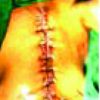 Vacuum-Assisted Closure in Patients with Post-operative Infections after Instrumented Spine Surgery: A Series of 12 Cases
