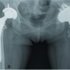 Pseudotumour Complicated by Implant Loosening One Year After revision Ceramic on Metal Total Hip Arthroplasty: A Case Report