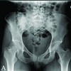 Management of Pelvic Chondroblastic Osteosarcoma after Urgent Spinal Decompression – A Report of 2 Cases